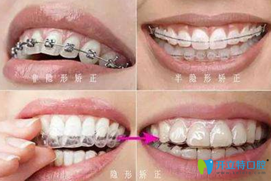 北京维尔口腔医生告诉你:一般矫正牙齿多少钱?