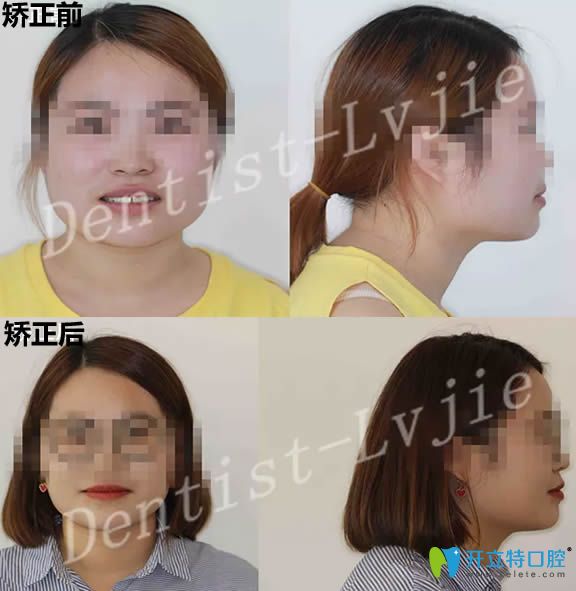 北京圣贝口腔28岁顾客牙齿矫正案例 来看正畸前后对比