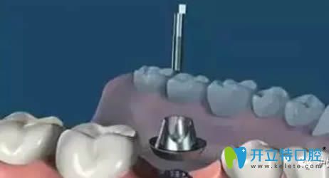 种植牙手术全过程图解