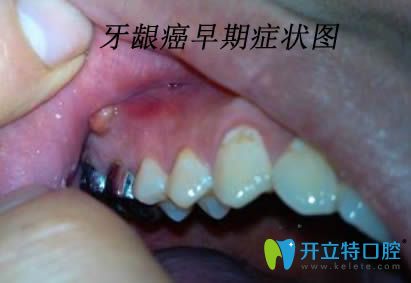 答案:牙龈癌早期即表现为溃疡,起病初期会在牙间乳头及龈缘区域出现