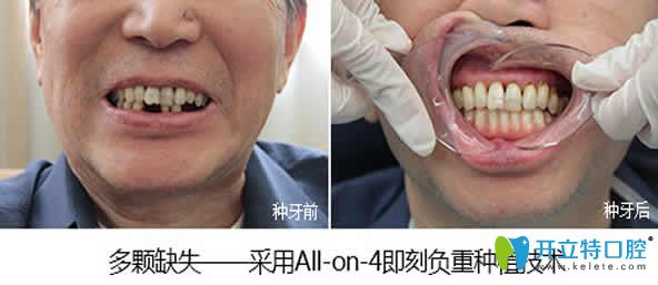 福州同福医口腔即刻种植牙前后对比图
