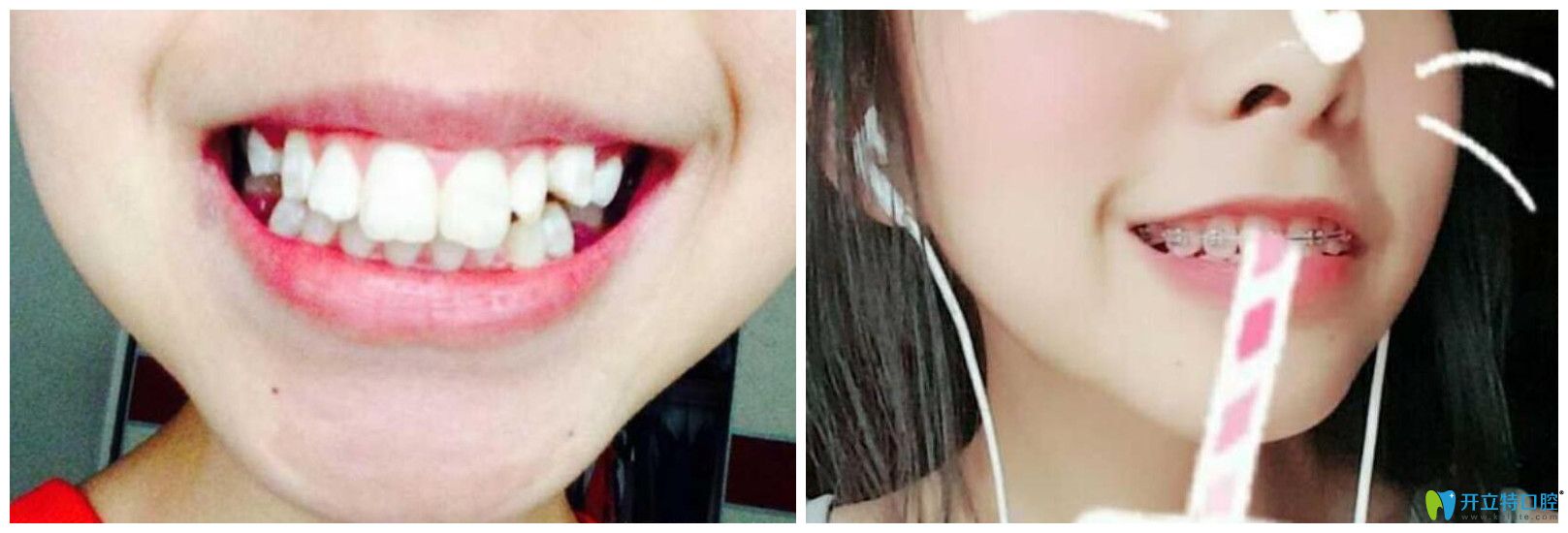 兔牙矫正牙齿会改变脸型吗?