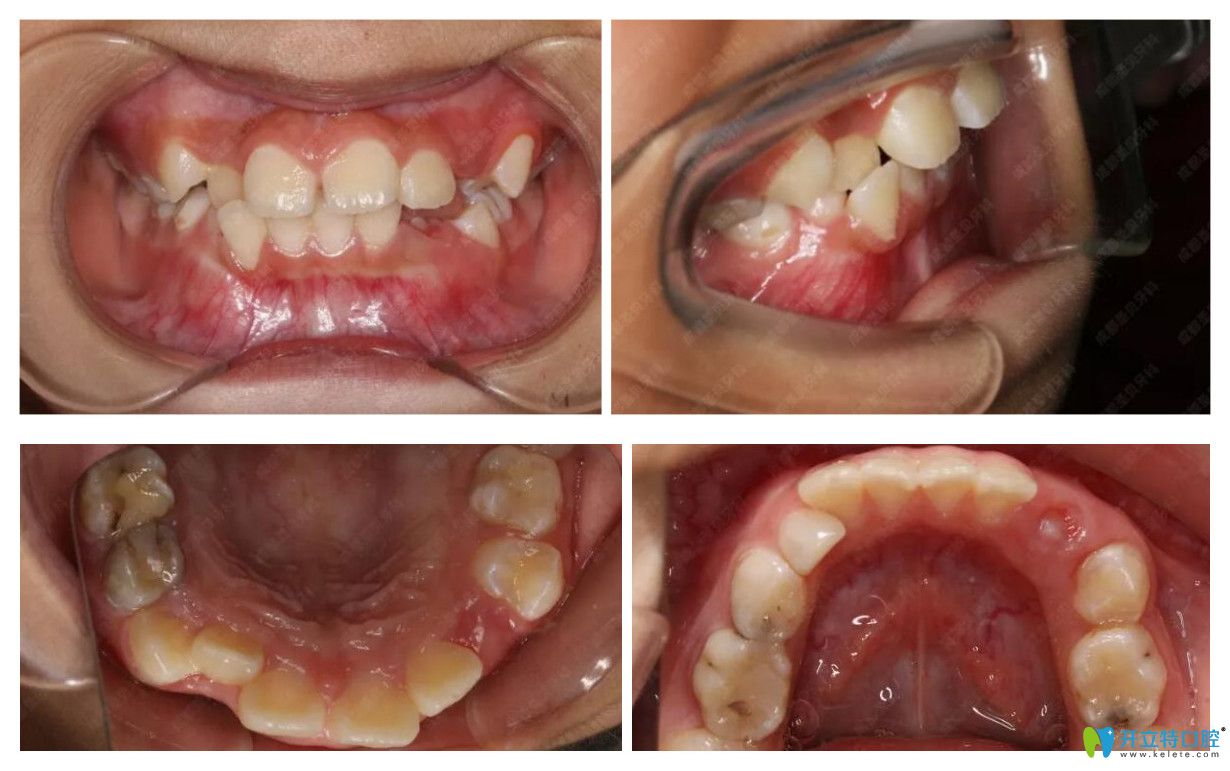 小孩轻微龅牙,个别牙反颌在成都圣贝口腔做正畸案例效果