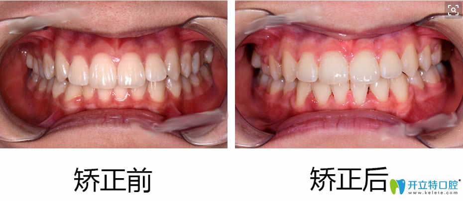 请看天包地牙齿矫正价格表