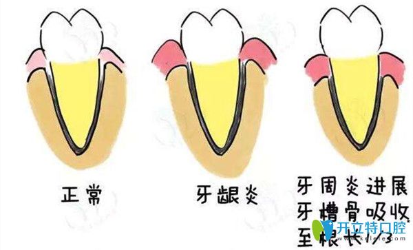口腔疾病牙周炎的发展史