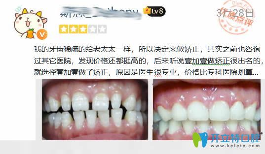 广州壹加壹牙齿稀疏选择隐形矫正后的案例效果及评价