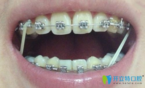虽然带牙套的过程是缓慢且复杂的,不仅有戴橡皮圈的麻烦,还有各种