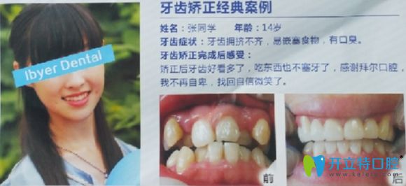 深圳拜尔口腔牙齿矫正案例前后效果对比图
