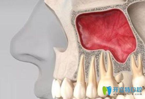 弄清了上颌窦内外提升术你就知道种牙时上颌窦提升危险不