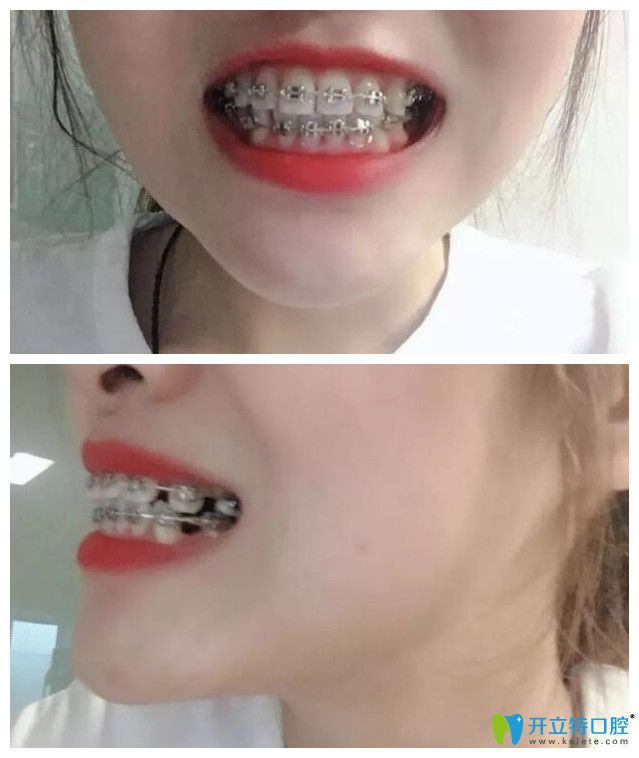 收缝过程牙齿变化更大,牙齿前突的情况进一步得到改善,拔牙的缝隙也