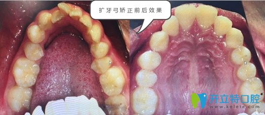 扩弓矫正的前后效果对比图