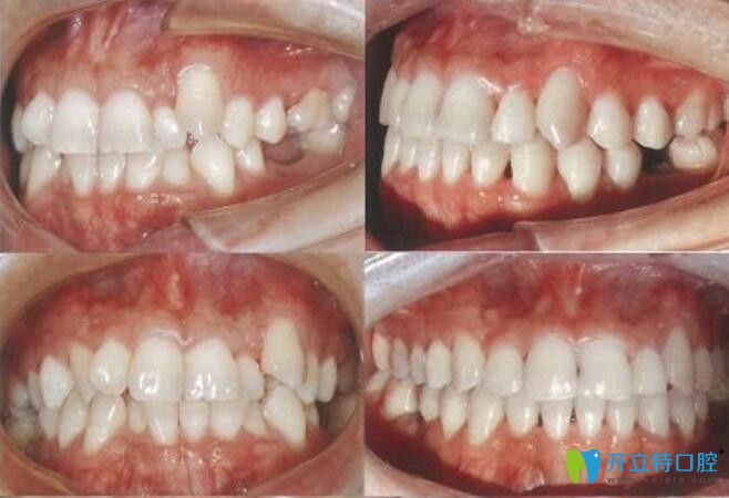 看在重庆团圆口腔做的牙齿不齐 虎牙的隐形矫正之后的效果怎么样?
