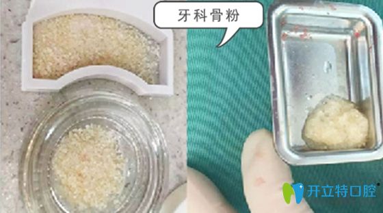 来自牙科骨粉的疑惑种植牙骨粉是什么材料价格为何这么贵