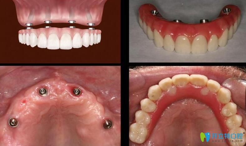 南京博韵口腔allon4半口种植牙案例