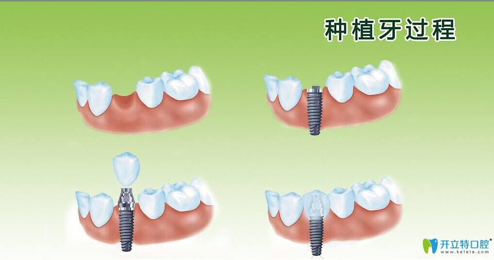 从一段式和二段式种植体区别解析二段种植体的组成