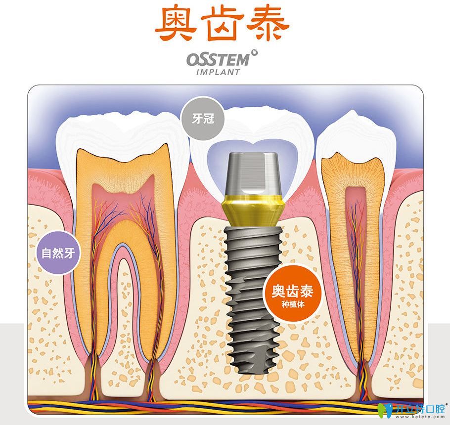干货:韩国登特斯种植体什么档次?奥齿泰和登特斯有什么区别