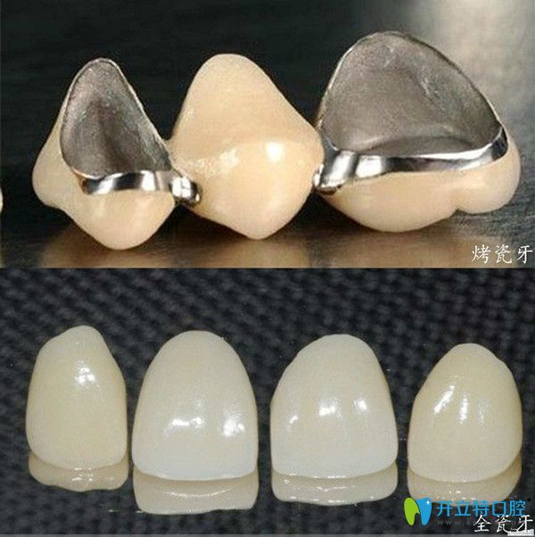 2,全瓷牙不像烤瓷牙那样会对邻牙有磨损.3,全瓷牙没有牙龈"黑线"问题.