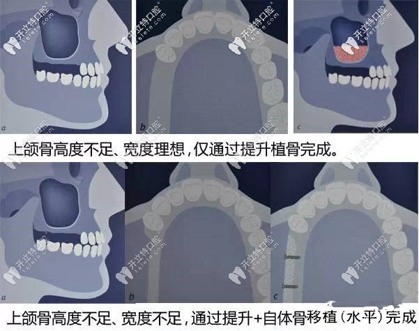 想做上颌窦外提升术的却又关心风险大不大看本文就够了