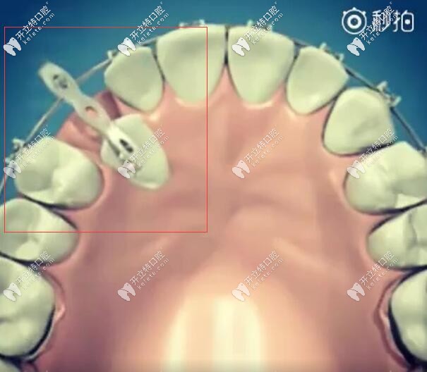 正畸经历了埋伏牙开窗牵引原来痛苦是自己想出来的