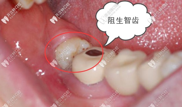 阻生智齿也可以通过牵引来替代磨牙
