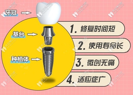 这是真的现在北京做美国皓圣种植牙比原价格便宜一半呢