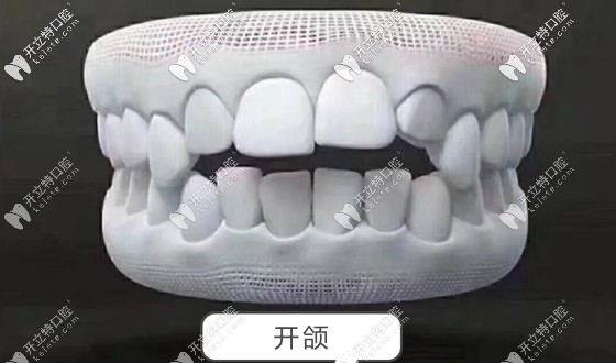 注:当你咬牙时,牙齿无法闭合,上下之间有缝,这种症状就叫-开颌.