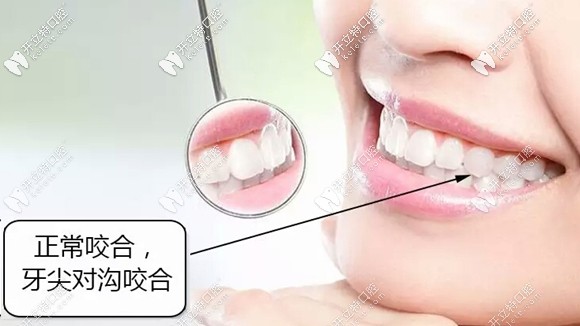 正常的牙齿咬合应该是上排牙齿的窝,对下排牙齿的尖,上排牙盖住下排牙