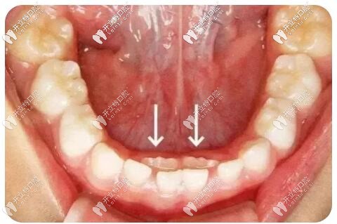 奶牙未掉恒牙长出的乳牙滞留必须拔除,否则危害多多