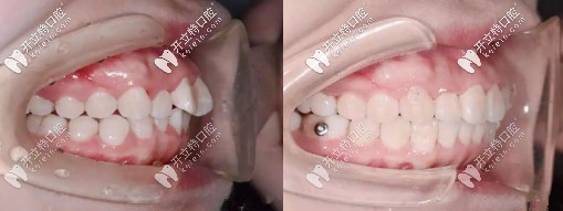 兔子牙矫正前后对比照来喽,我是戴时代天使隐形牙套矫正滴