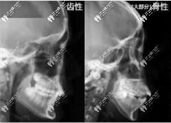下巴后缩凸嘴想戴隐形牙套矫正首先要区分是牙性还是骨性