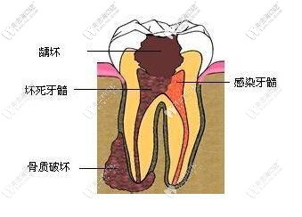 激光治疗牙髓病更快速更安全