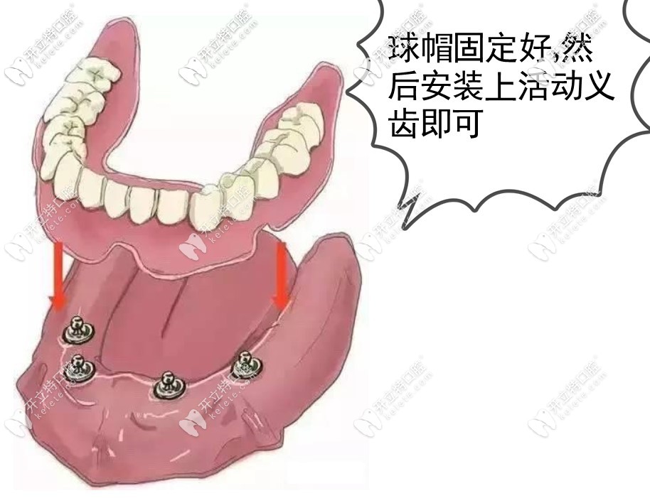 上海口腔医院 上海摩尔口腔医院 > 内容详情页  半口半固定种植牙,也