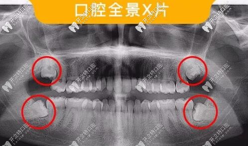 正常人28颗牙,也有人32颗牙,其中4颗就是智齿,上颌下颌左右各一颗