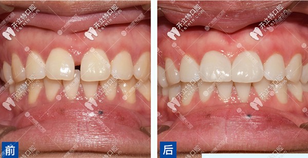 对于牙齿稀疏,牙缝宽大的美容修复,更是佳选!