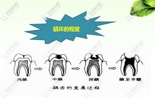 因为需要做牙冠也是为了保护牙齿,毕竟有的牙齿龋坏比较重,伤到了牙