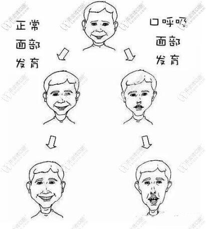 别让这种面型毁了娃儿童腺样体面容戴mrc矫正器能矫正吗