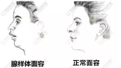 别让这种面型毁了娃,儿童腺样体面容戴mrc矫正器能矫正吗?