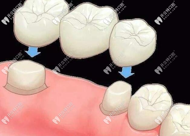 烤瓷牙基牙腐烂一摸手都是臭的,分享拆烤瓷牙的过程图片