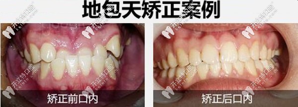 这价格忒低了吧深圳的韩国登腾种植牙全包价才2980元起
