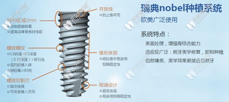 瑞典诺贝尔种植体特点