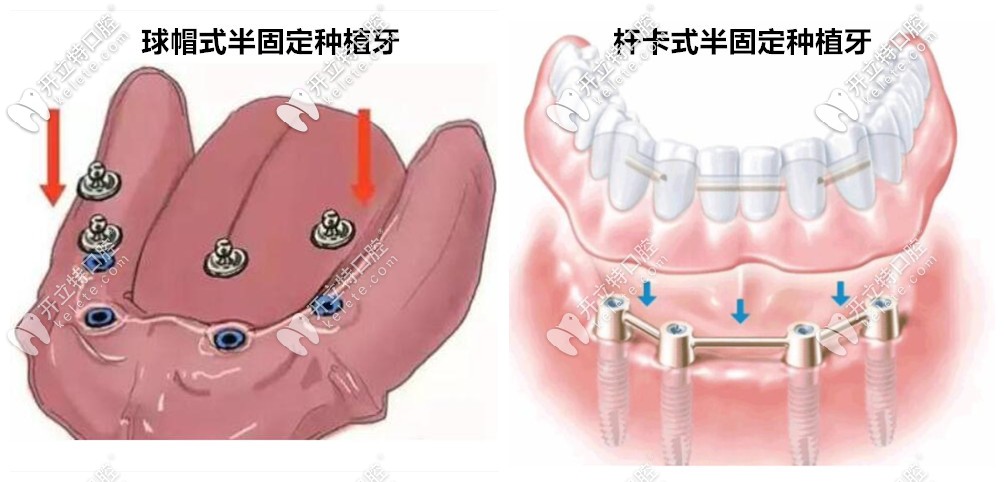 然后种植体和牙冠之间用球帽式精密附着体或杆卡式附着体连接在一起