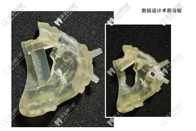 为了保证手术的精准性,需要制作3d打印颌骨模型,然后数码设计术前导板