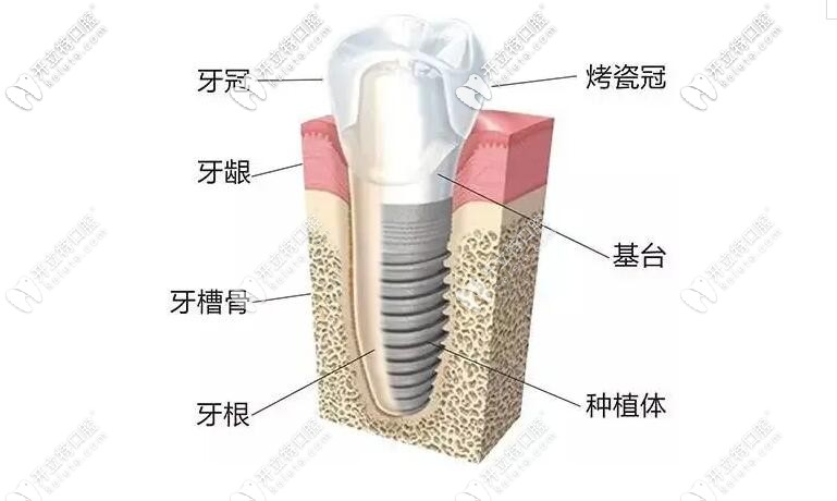 种植牙结构图介绍