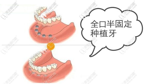 全口半固定种植牙