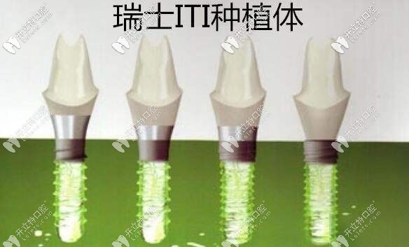 悄悄告诉你个秘密:瑞士iti瑞锆种植体也叫瑞士士卓曼瑞锆种植体