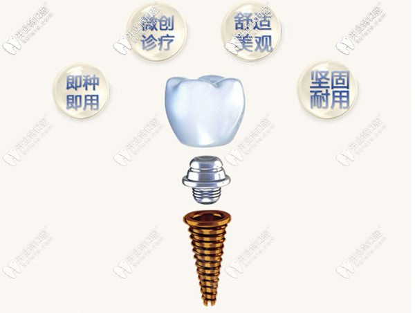 武汉缀美做一颗韩国osstem奥齿泰种植牙的价格才920元