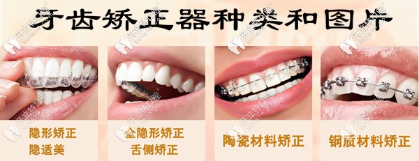 在天津做牙齿矫正的价格是多少?舌侧全隐形的这种