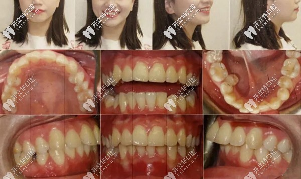 选济南美奥口腔做隐适美igo极速矫正,价格便宜效果还可人哦