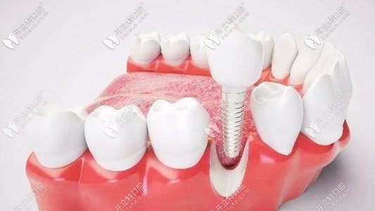 分享常熟牙博士做牙齿矫正和种植牙的价格表收费不贵哦