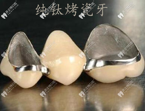 它是由两种材质组成,内部是金属材质:纯钛式的内冠,用来保护基牙